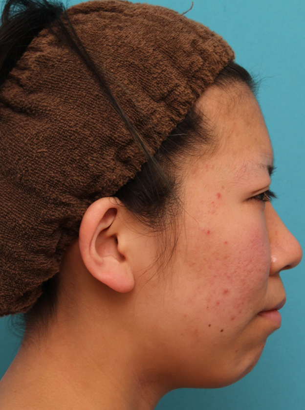 隆鼻術（シリコンプロテーゼ）,20代女性の、総合的なお鼻のお悩みを手術で改善した症例写真,手術前,mainpic_ryubi1052h.jpg
