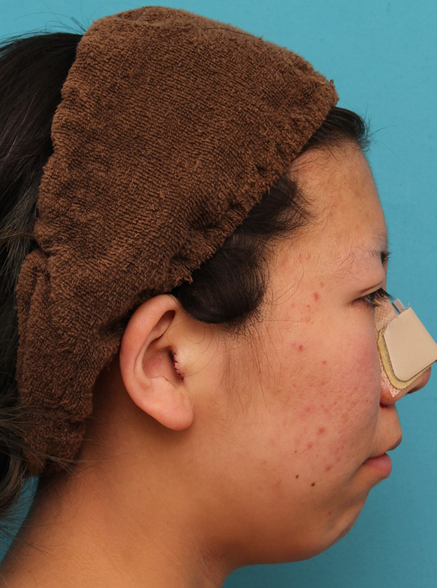 耳介軟骨移植（鼻先を出す）,20代女性の、総合的なお鼻のお悩みを手術で改善した症例写真,手術直後,mainpic_ryubi1052i.jpg