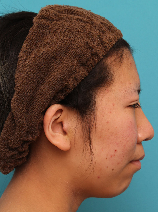鼻翼縮小（小鼻縮小）,20代女性の、総合的なお鼻のお悩みを手術で改善した症例写真,1週間後,mainpic_ryubi1052j.jpg