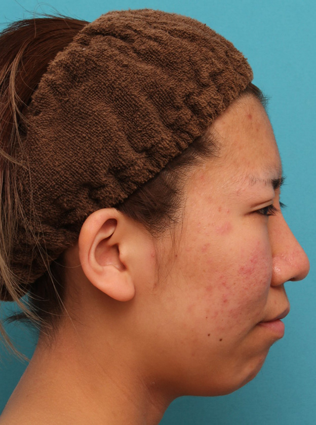 鼻翼縮小（小鼻縮小）,20代女性の、総合的なお鼻のお悩みを手術で改善した症例写真,1ヶ月後,mainpic_ryubi1052k.jpg