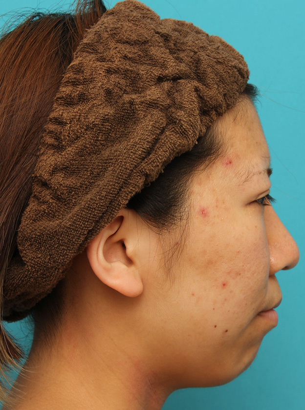 耳介軟骨移植（鼻先を出す）,20代女性の、総合的なお鼻のお悩みを手術で改善した症例写真,3ヶ月後,mainpic_ryubi1052l.jpg