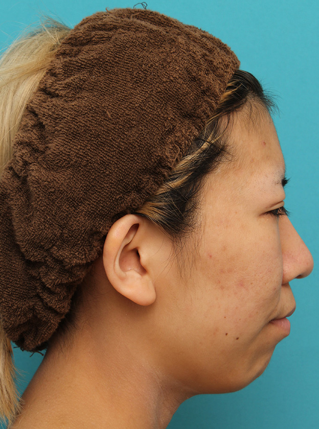 隆鼻術（シリコンプロテーゼ）,20代女性の、総合的なお鼻のお悩みを手術で改善した症例写真,6ヶ月後,mainpic_ryubi1052m.jpg