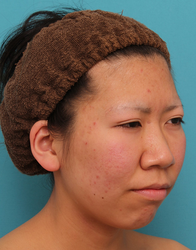 鼻翼縮小（小鼻縮小）,20代女性の、総合的なお鼻のお悩みを手術で改善した症例写真,手術前,mainpic_ryubi1052n.jpg