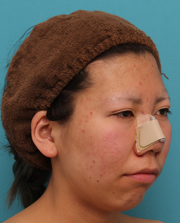 耳介軟骨移植（鼻先を出す）,20代女性の、総合的なお鼻のお悩みを手術で改善した症例写真,手術直後,mainpic_ryubi1052o.jpg