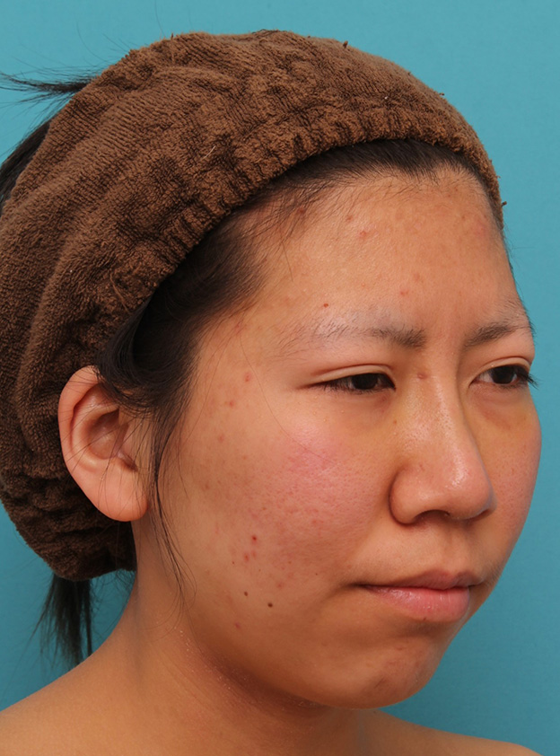 隆鼻術（シリコンプロテーゼ）,20代女性の、総合的なお鼻のお悩みを手術で改善した症例写真,1週間後,mainpic_ryubi1052p.jpg