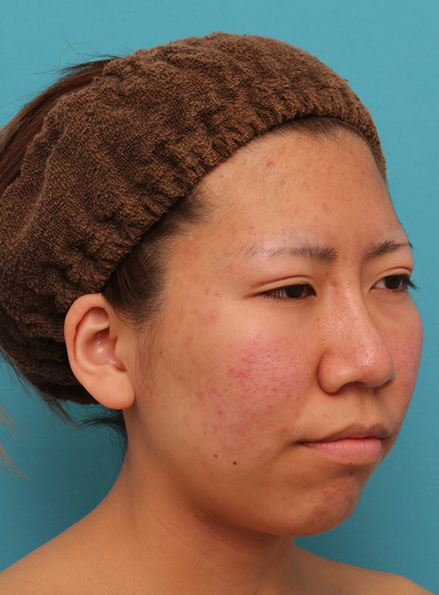 隆鼻術（シリコンプロテーゼ）,20代女性の、総合的なお鼻のお悩みを手術で改善した症例写真,1ヶ月後,mainpic_ryubi1052q.jpg