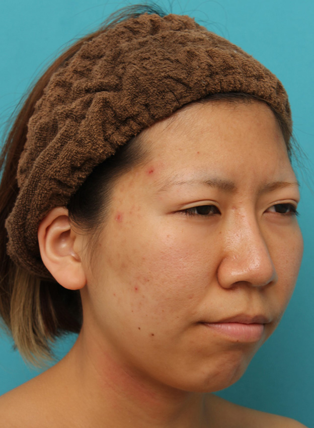 鼻翼縮小（小鼻縮小）,20代女性の、総合的なお鼻のお悩みを手術で改善した症例写真,3ヶ月後,mainpic_ryubi1052r.jpg