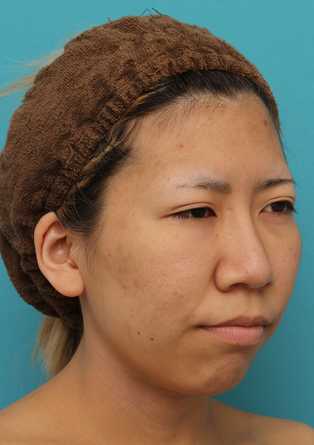 鼻翼縮小（小鼻縮小）,20代女性の、総合的なお鼻のお悩みを手術で改善した症例写真,6ヶ月後,メイクなし,mainpic_ryubi1052s.jpg