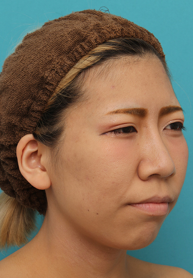 耳介軟骨移植（鼻先を出す）,20代女性の、総合的なお鼻のお悩みを手術で改善した症例写真,6ヶ月後,メイクあり,mainpic_ryubi1052t.jpg