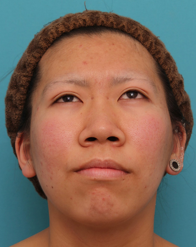 隆鼻術（シリコンプロテーゼ）,20代女性の、総合的なお鼻のお悩みを手術で改善した症例写真,手術前,mainpic_ryubi1052u.jpg