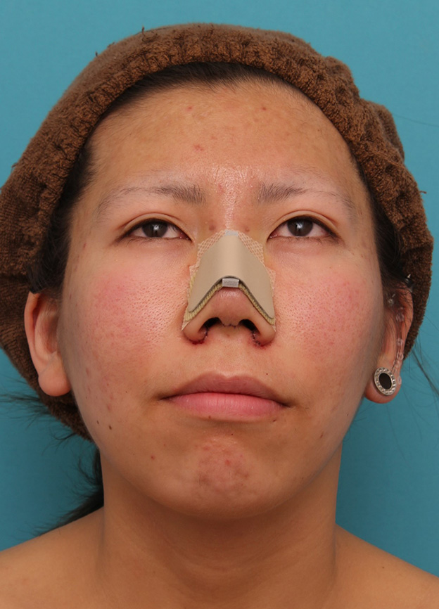 鼻翼縮小（小鼻縮小）,20代女性の、総合的なお鼻のお悩みを手術で改善した症例写真,手術直後,mainpic_ryubi1052v.jpg