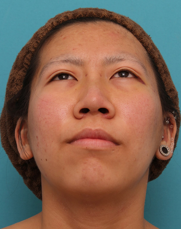 鼻翼縮小（小鼻縮小）,20代女性の、総合的なお鼻のお悩みを手術で改善した症例写真,1週間後,mainpic_ryubi1052w.jpg