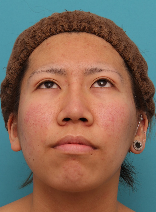 耳介軟骨移植（鼻先を出す）,20代女性の、総合的なお鼻のお悩みを手術で改善した症例写真,1ヶ月後,mainpic_ryubi1052x.jpg