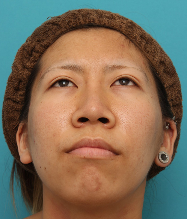 鼻翼縮小（小鼻縮小）,20代女性の、総合的なお鼻のお悩みを手術で改善した症例写真,3ヶ月後,mainpic_ryubi1052y.jpg