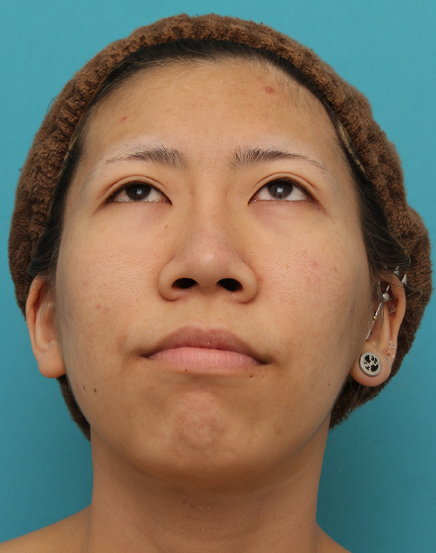 鼻翼縮小（小鼻縮小）,20代女性の、総合的なお鼻のお悩みを手術で改善した症例写真,6ヶ月後,メイクなし,mainpic_ryubi1052z.jpg