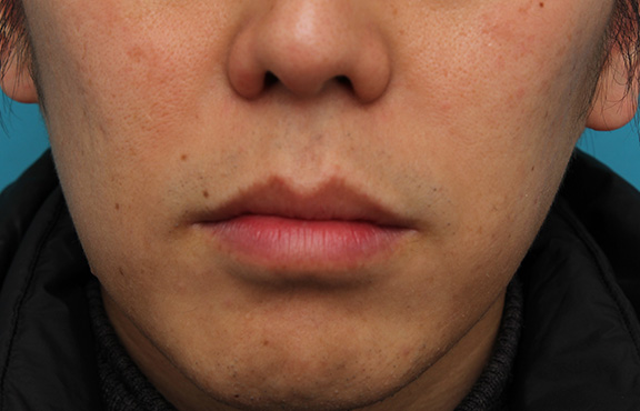 唇を薄く（口唇縮小術）,上下の唇を薄くする手術の症例写真,After（1ヶ月後）,ba_usuku011_a01.jpg