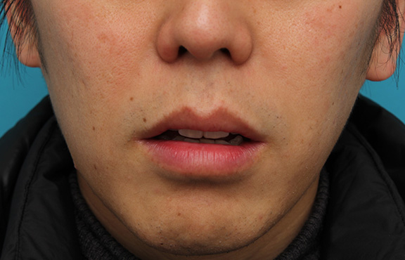 唇を薄く（口唇縮小術）,上下の唇を薄くする手術の症例写真,After（1ヶ月後）,ba_usuku011_b02.jpg