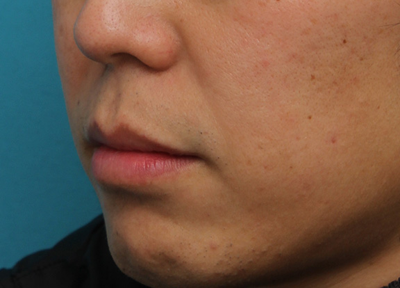 唇を薄く（口唇縮小術）,上下の唇を薄くする手術の症例写真,After（1ヶ月後）,ba_usuku011_b03.jpg