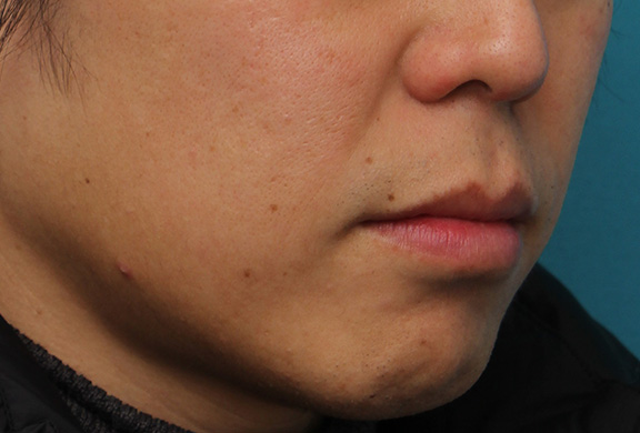 唇を薄く（口唇縮小術）,上下の唇を薄くする手術の症例写真,After（1ヶ月後）,ba_usuku011_b04.jpg