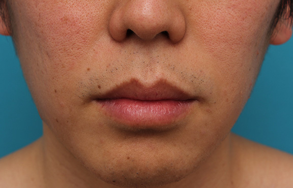 唇を薄く（口唇縮小術）,上下の唇を薄くする手術の症例写真,Before,ba_usuku011_b01.jpg