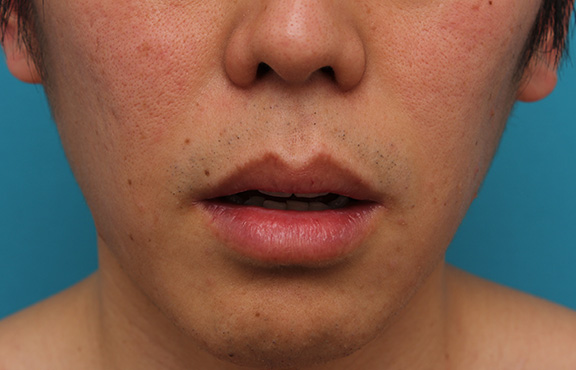 唇を薄く（口唇縮小術）,上下の唇を薄くする手術の症例写真,Before,ba_usuku011_b02.jpg