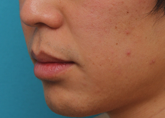 唇を薄く（口唇縮小術）,上下の唇を薄くする手術の症例写真,Before,ba_usuku011_b03.jpg