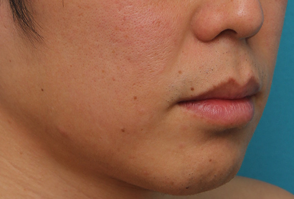 唇を薄く（口唇縮小術）,上下の唇を薄くする手術の症例写真,Before,ba_usuku011_b04.jpg