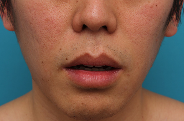 唇を薄く（口唇縮小術）,上下の唇を薄くする手術の症例写真,手術前,口を開けた状態,mainpic_usuku011b.jpg