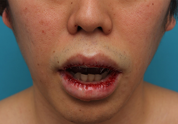 症例写真,上下の唇を薄くする手術の症例写真,手術直後,口を開けた状態,mainpic_usuku011d.jpg