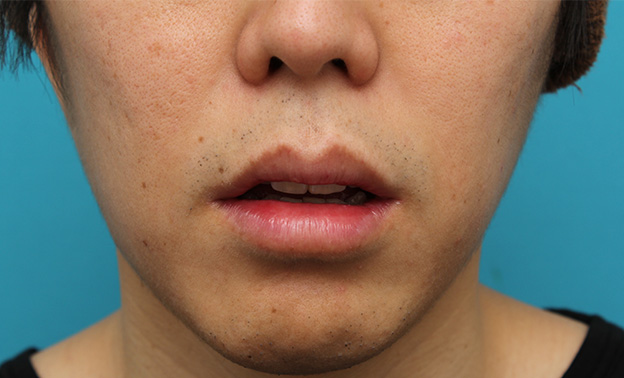 唇を薄く（口唇縮小術）,上下の唇を薄くする手術の症例写真,13日後（抜糸時）,口を開けた状態,mainpic_usuku011f.jpg