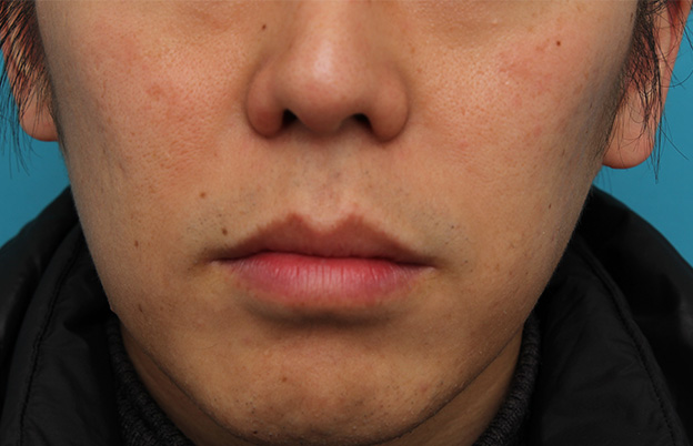 唇を薄く（口唇縮小術）,上下の唇を薄くする手術の症例写真,1ヶ月後,口を閉じた状態,mainpic_usuku011g.jpg