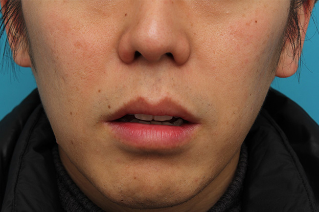 唇を薄く（口唇縮小術）,上下の唇を薄くする手術の症例写真,1ヶ月後,口を開けた状態,mainpic_usuku011h.jpg
