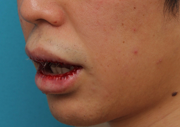 唇を薄く（口唇縮小術）,上下の唇を薄くする手術の症例写真,手術直後,口を開けた状態,mainpic_usuku011l.jpg