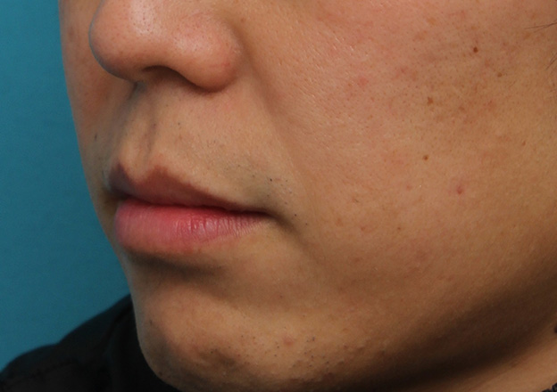 唇を薄く（口唇縮小術）,上下の唇を薄くする手術の症例写真,1ヶ月後,mainpic_usuku011o.jpg