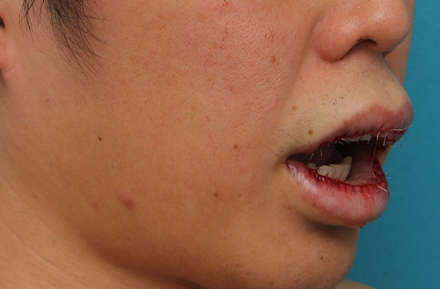 唇を薄く（口唇縮小術）,上下の唇を薄くする手術の症例写真,手術直後,口を開けた状態,mainpic_usuku011s.jpg
