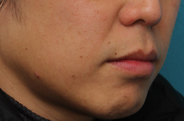 唇を薄く（口唇縮小術）,上下の唇を薄くする手術の症例写真,1ヶ月後,mainpic_usuku011v.jpg