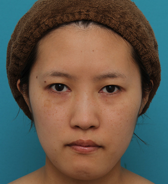 ミニフェイスリフト（頬のたるみ取り）,ミニフェイスリフトの症例 20代女性の頬を中心としたお顔のたるみの改善,After（3ヶ月後）,ba_minilift007_b01.jpg