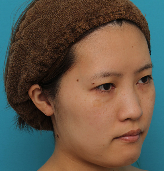 ミニフェイスリフト（頬のたるみ取り）,ミニフェイスリフトの症例 20代女性の頬を中心としたお顔のたるみの改善,After（3ヶ月後）,ba_minilift007_b02.jpg