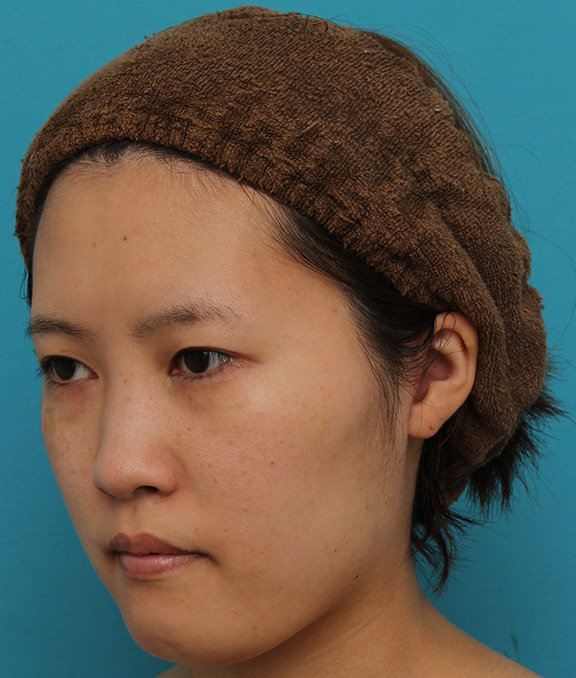 ミニフェイスリフト（頬のたるみ取り）,ミニフェイスリフトの症例 20代女性の頬を中心としたお顔のたるみの改善,After（3ヶ月後）,ba_minilift007_b03.jpg