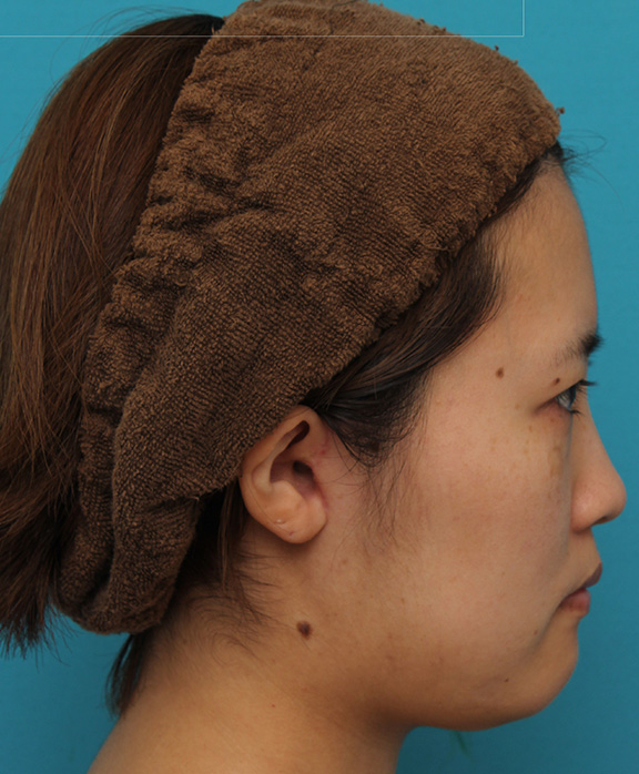 ミニフェイスリフト（頬のたるみ取り）,ミニフェイスリフトの症例 20代女性の頬を中心としたお顔のたるみの改善,After（3ヶ月後）,ba_minilift007_b04.jpg