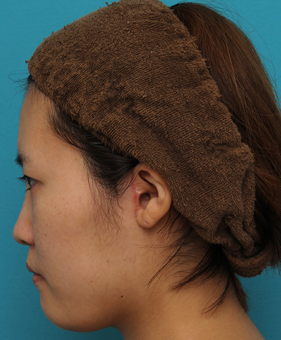 ミニフェイスリフト（頬のたるみ取り）,ミニフェイスリフトの症例 20代女性の頬を中心としたお顔のたるみの改善,After（3ヶ月後）,ba_minilift007_b05.jpg