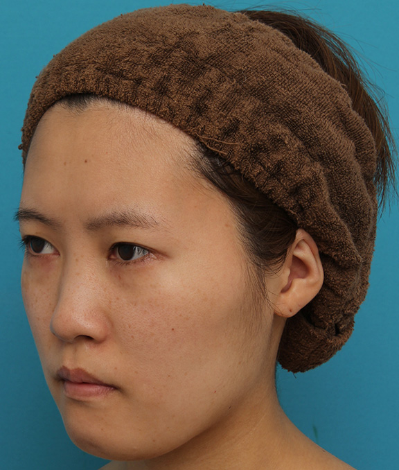 ミニフェイスリフト（頬のたるみ取り）,ミニフェイスリフトの症例 20代女性の頬を中心としたお顔のたるみの改善,Before,ba_minilift007_b03.jpg
