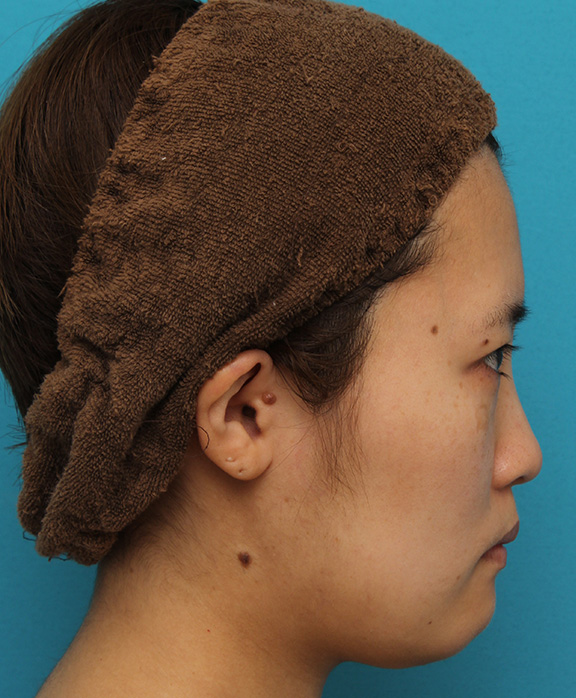 ミニフェイスリフト（頬のたるみ取り）,ミニフェイスリフトの症例 20代女性の頬を中心としたお顔のたるみの改善,Before,ba_minilift007_b04.jpg