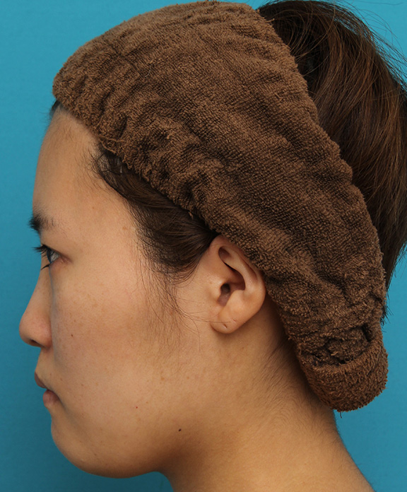 ミニフェイスリフト（頬のたるみ取り）,ミニフェイスリフトの症例 20代女性の頬を中心としたお顔のたるみの改善,Before,ba_minilift007_b05.jpg