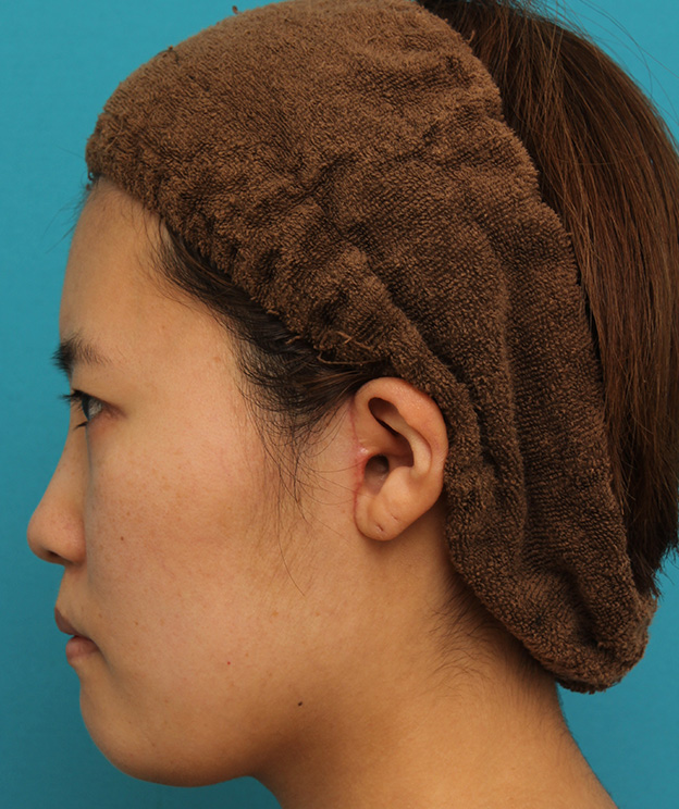 ミニフェイスリフト（頬のたるみ取り）,ミニフェイスリフトの症例 20代女性の頬を中心としたお顔のたるみの改善,1ヶ月後,mainpic_minilift007ab.jpg
