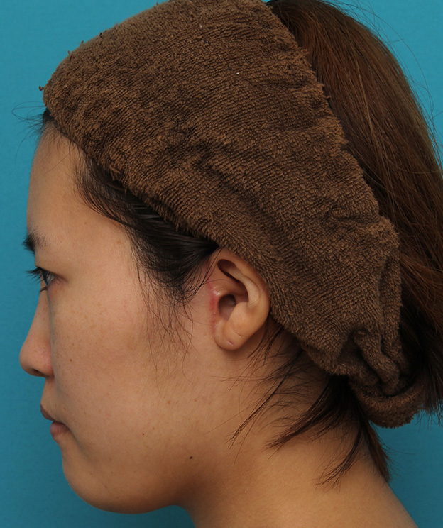 ミニフェイスリフト（頬のたるみ取り）,ミニフェイスリフトの症例 20代女性の頬を中心としたお顔のたるみの改善,3ヶ月後,mainpic_minilift007ac.jpg