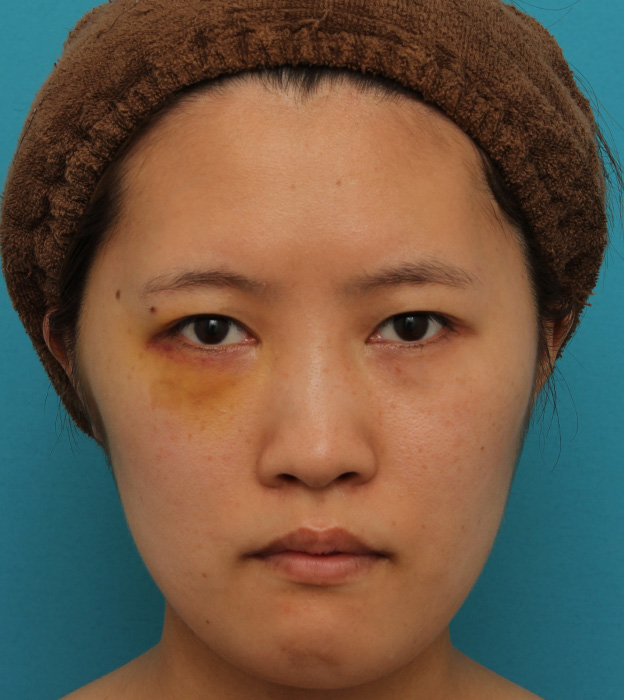 ミニフェイスリフト（頬のたるみ取り）,ミニフェイスリフトの症例 20代女性の頬を中心としたお顔のたるみの改善,1週間後（抜糸時）,mainpic_minilift007c.jpg
