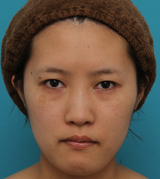 ミニフェイスリフト（頬のたるみ取り）,ミニフェイスリフトの症例 20代女性の頬を中心としたお顔のたるみの改善,3ヶ月後,mainpic_minilift007e.jpg
