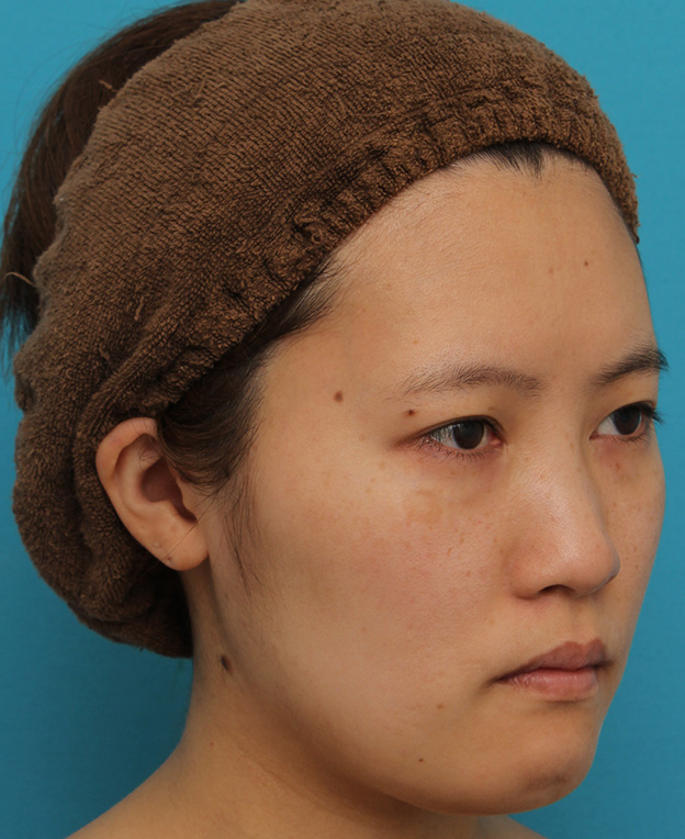 ミニフェイスリフト（頬のたるみ取り）,ミニフェイスリフトの症例 20代女性の頬を中心としたお顔のたるみの改善,手術前,mainpic_minilift007f.jpg