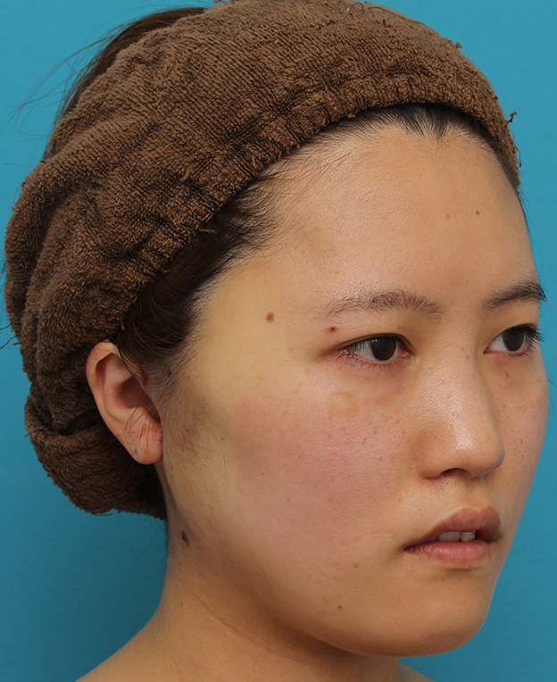 ミニフェイスリフト（頬のたるみ取り）,ミニフェイスリフトの症例 20代女性の頬を中心としたお顔のたるみの改善,手術直後,mainpic_minilift007g.jpg